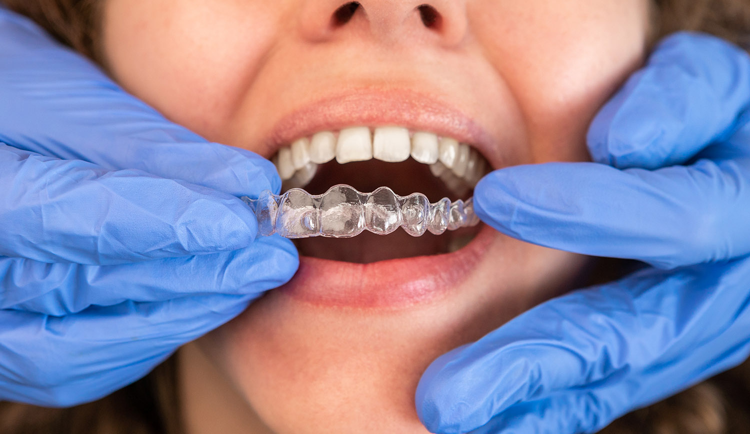 Clear Aligners closeup being inserted on to teeth
