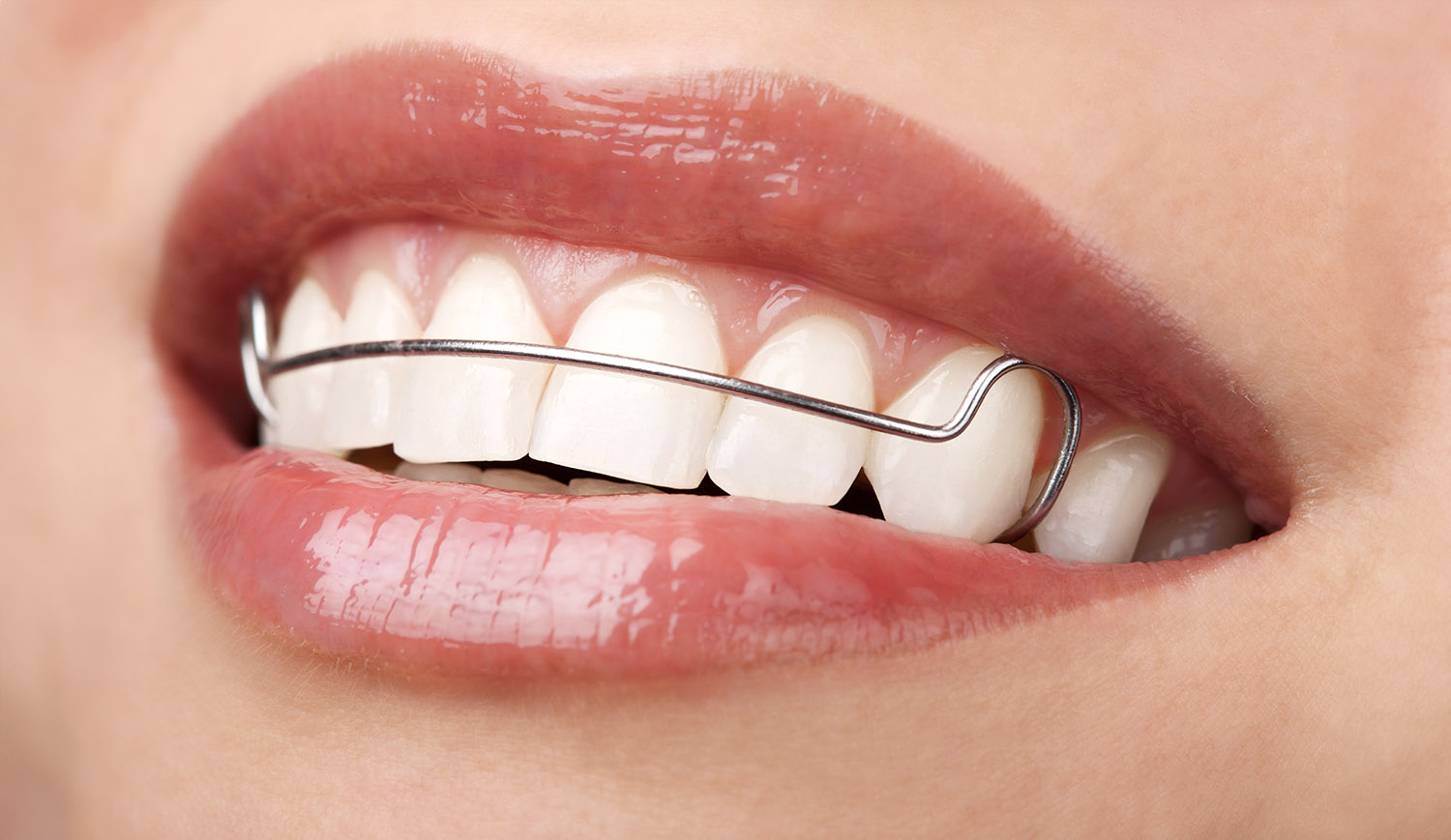 Mouth closeup of an interceptive treatment