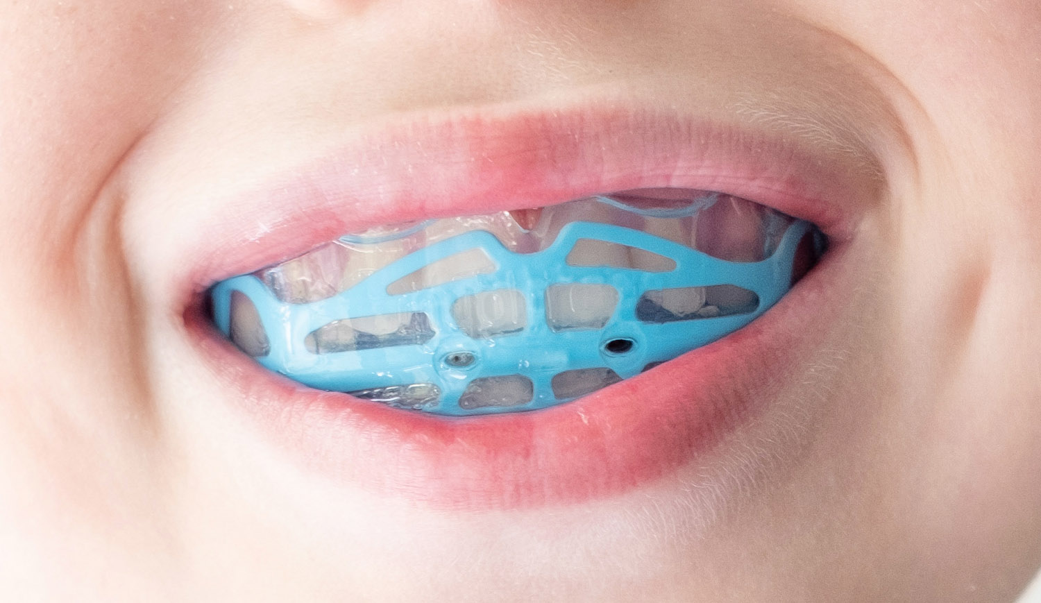 Mouthguards