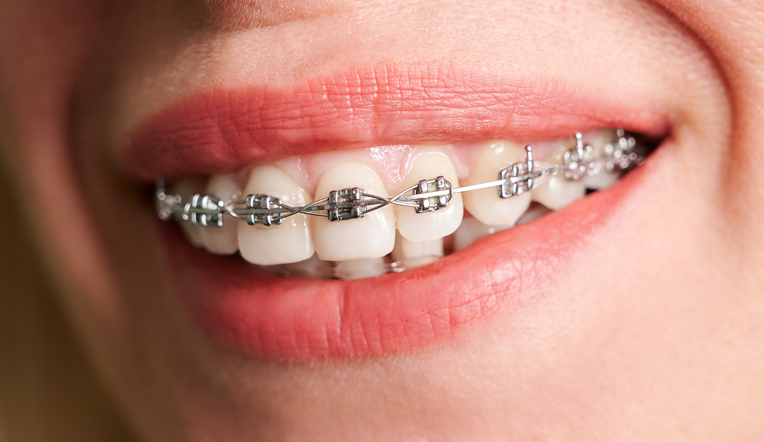 Traditional Braces